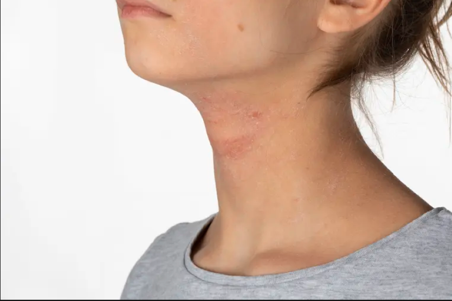 Liječenje atopijskog dermatitisa kod odraslih Virtualna ordinacija