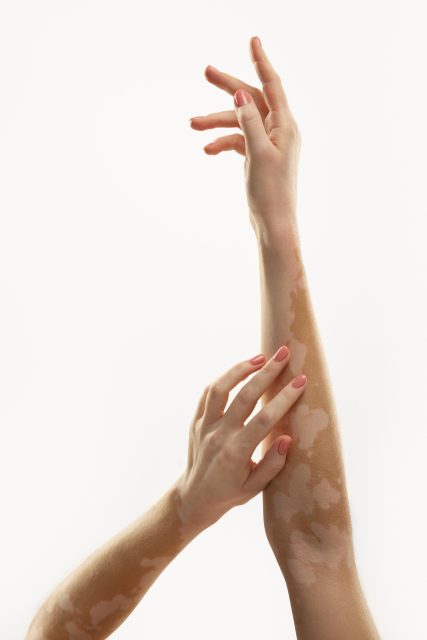 Virtualna ordinacija_Vitiligo (3)